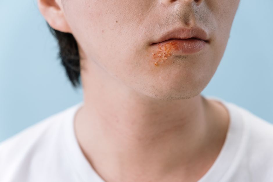 ¿Cuánto tarda en desaparecer un herpes labial?